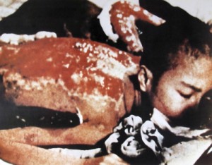 Radiation Burns from a victim in Hiroshima. 