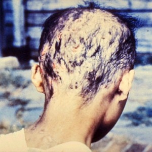 Hair loss from radiation