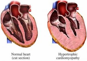 normal vs HCM heart