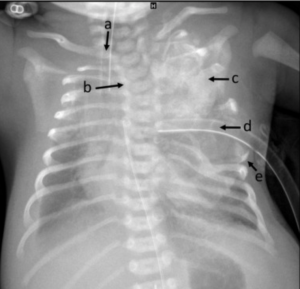 X-ray of chest